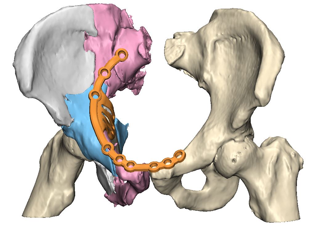 UMCG voert eerste bekkenreconstructie met 3D-technologie uit