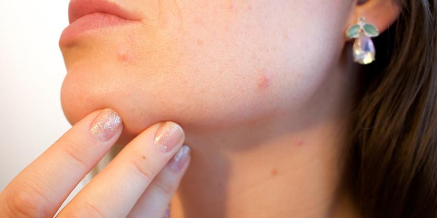 Meerderheid van patiënten met acne krijgt medicatie voorgeschreven