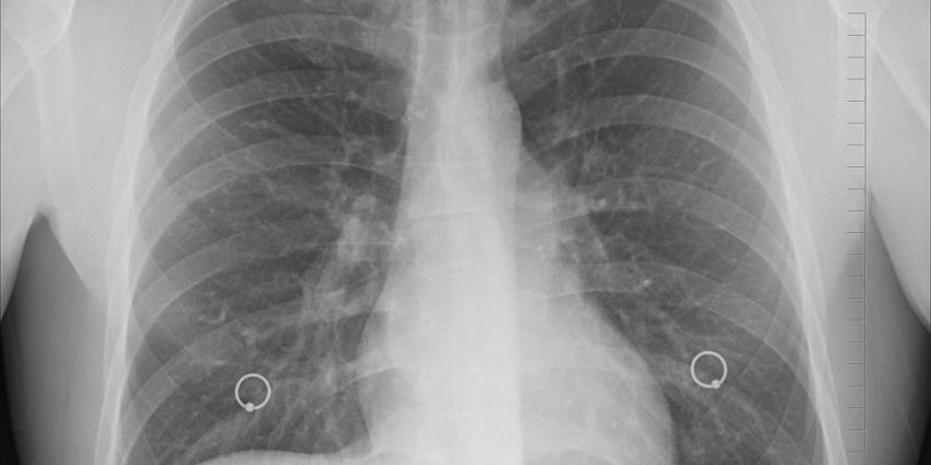 Iets meer tuberculosepatiënten in Nederland