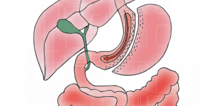 Maagverkleining kan nieuwe ‘gouden standaard’ worden tegen ernstig overgewicht    