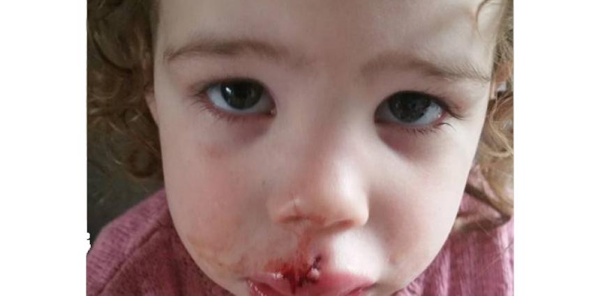 Meisje (2) in gezicht gebeten door hond