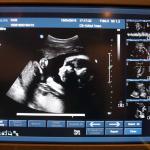 echo-baby-ziekenhuis-monitor