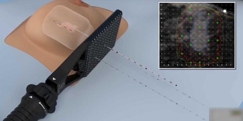  Erasmus MC start met implanteren radioactieve 'zaadjes' tegen borstkanker