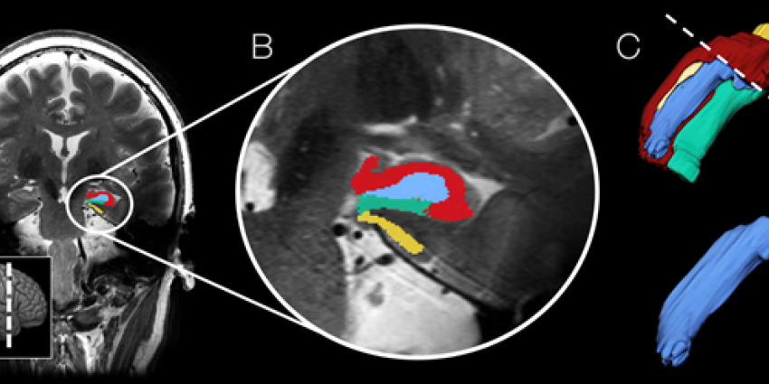 Depressie-behandeling met electroshock maakt nieuwe zenuwcellen aan