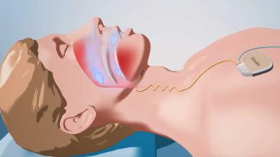 Ernstige vorm van apneu te behandelen met tongzenuwstimulator 