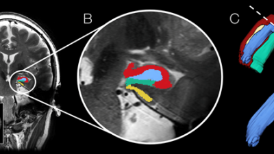 Depressie-behandeling met electroshock maakt nieuwe zenuwcellen aan
