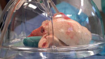 ‘Patching up’ donor lungs leads to significantly more transplants