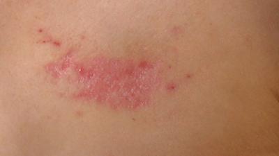 Ruim 1,2 miljoen Nederlanders hebben eczeem of psoriasis